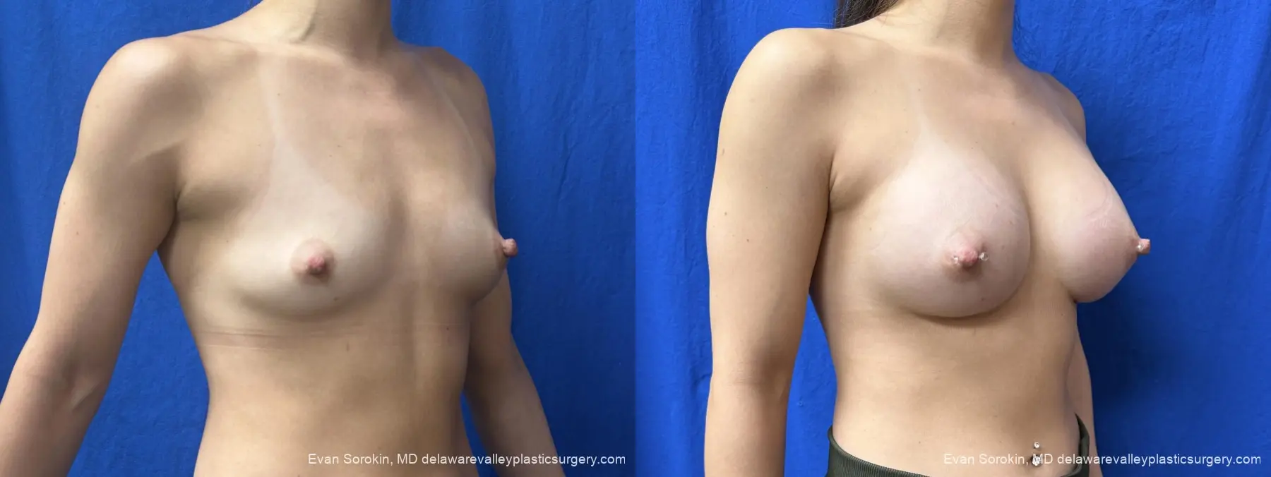 Breast Augmentation: Patient 278 - Before and After 2
