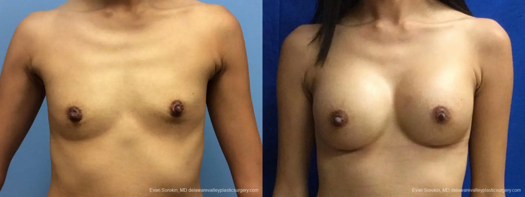 Philadelphia Breast Augmentation 13071 - Before and After 1