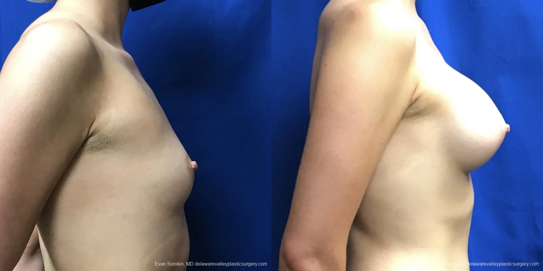 Breast Augmentation: Patient 170 - Before and After 4