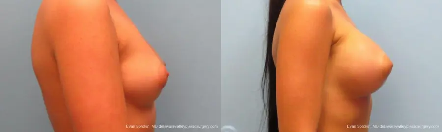 Breast Augmentation: Patient 11 - Before and After 3