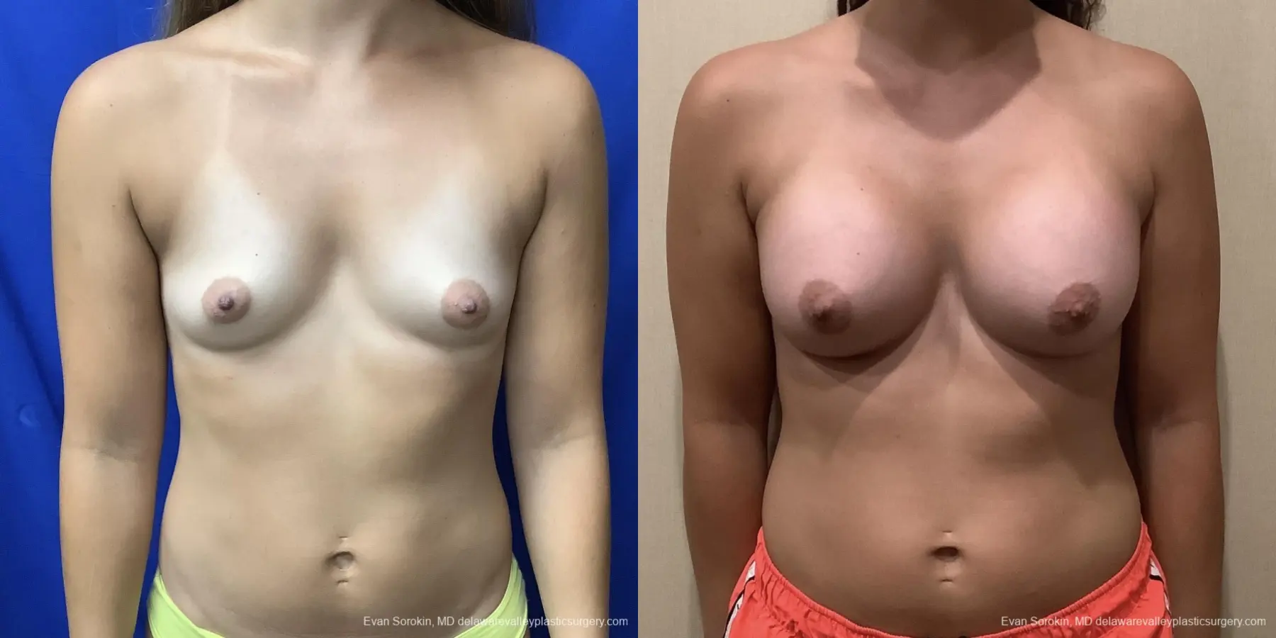 Breast Augmentation: Patient 185 - Before and After 1