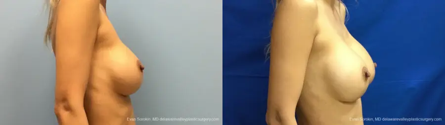 Philadelphia Breast Augmentation 13178 - Before and After 3