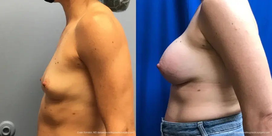 Breast Augmentation: Patient 212 - Before and After 5