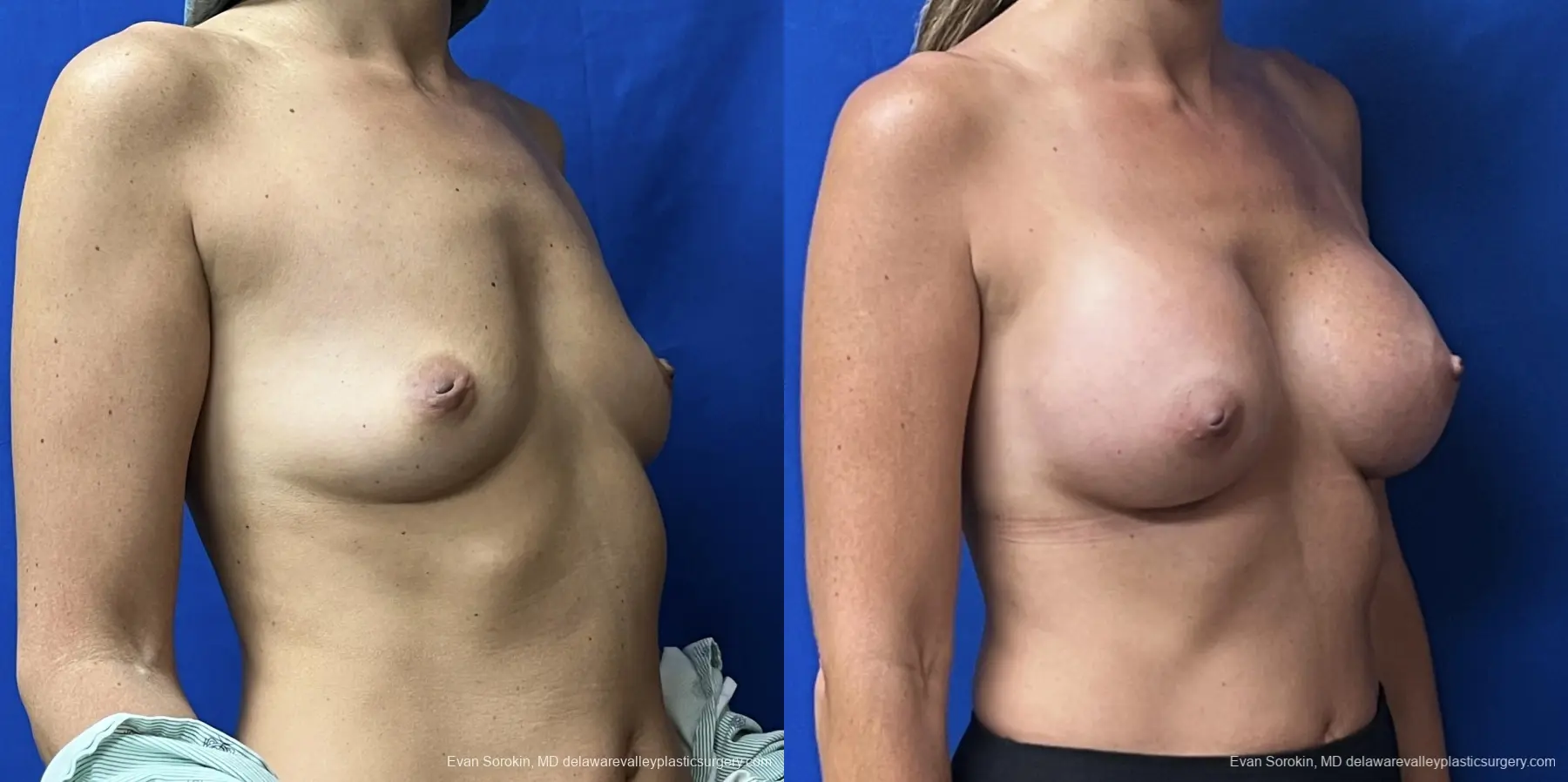Breast Augmentation: Patient 230 - Before and After 2