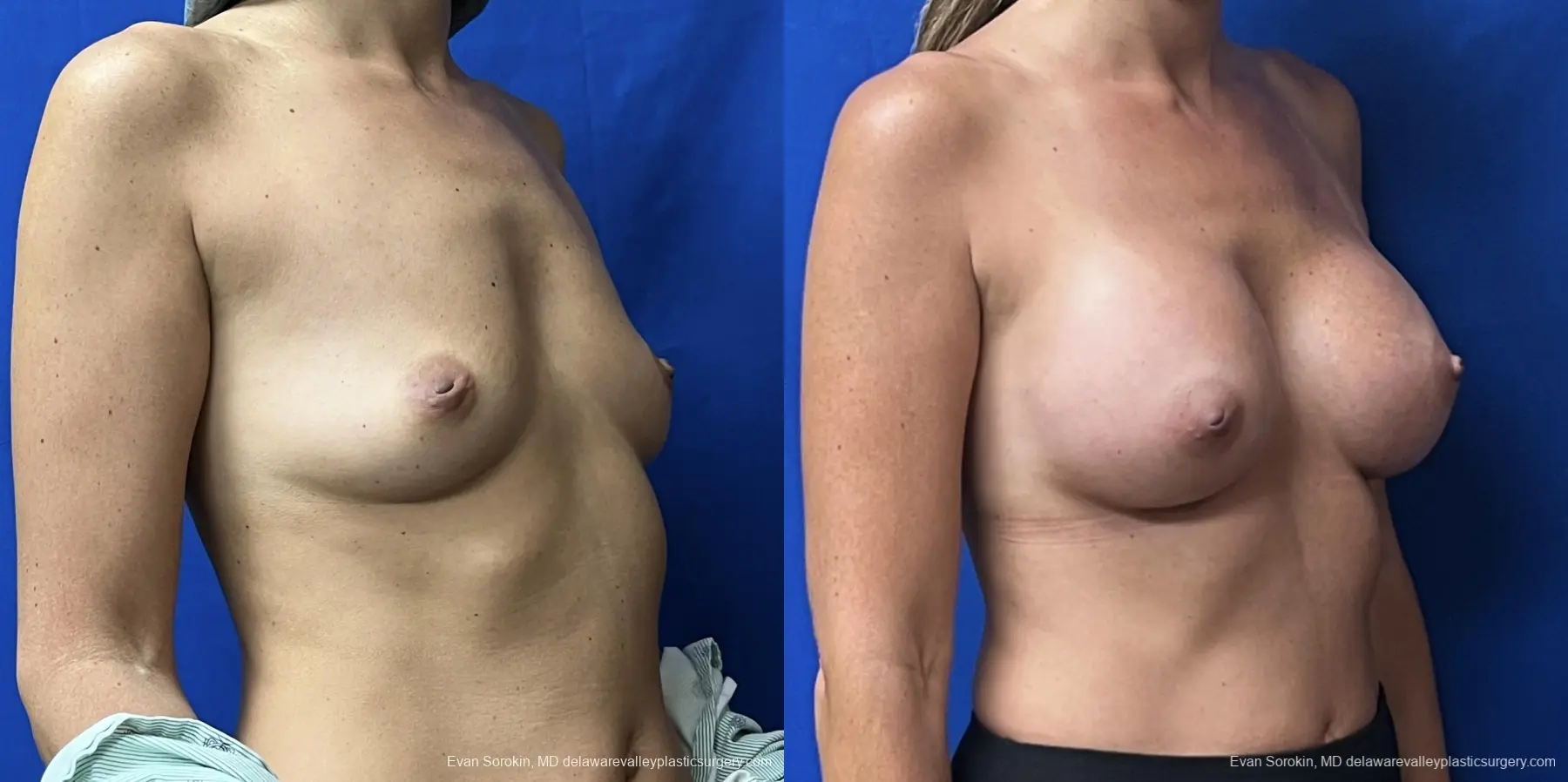 Breast Augmentation: Patient 198 - Before and After 2