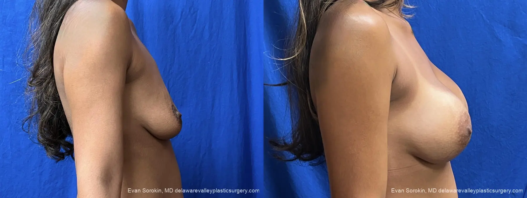 Breast Augmentation: Patient 308 - Before and After 3
