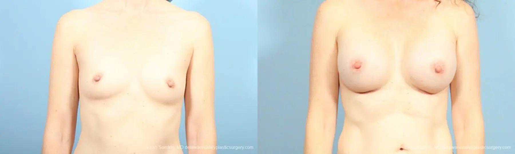 Philadelphia Breast Augmentation 8662 - Before and After 1