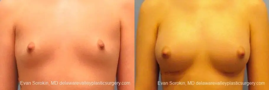 Philadelphia Breast Augmentation 10113 - Before and After 1