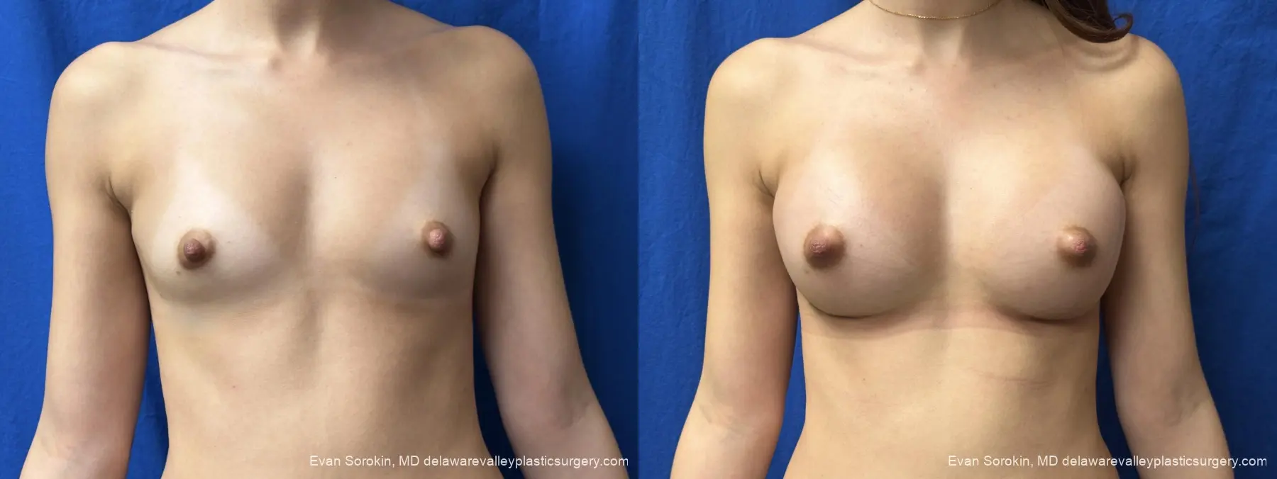 Breast Augmentation: Patient 2 - Before and After