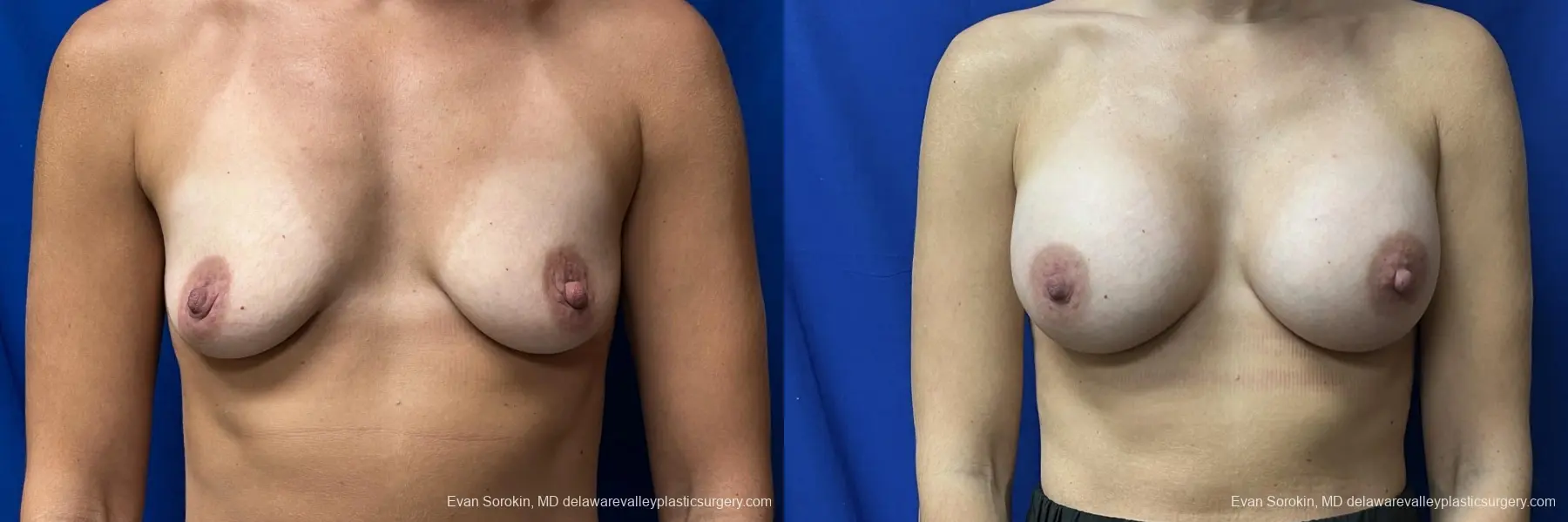 Breast Augmentation: Patient 203 - Before and After 1