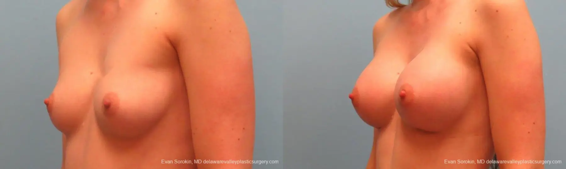 Philadelphia Breast Augmentation 9381 - Before and After 4