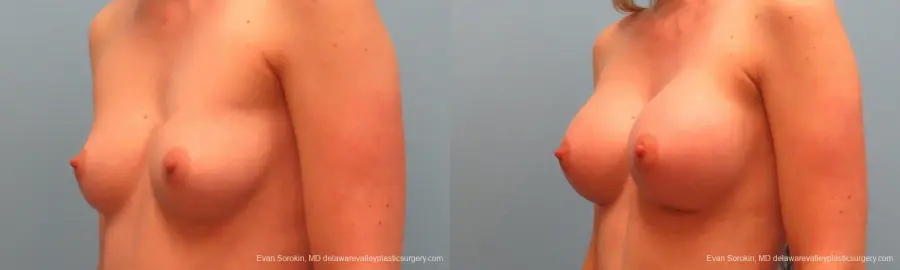 Philadelphia Breast Augmentation 9381 - Before and After 4