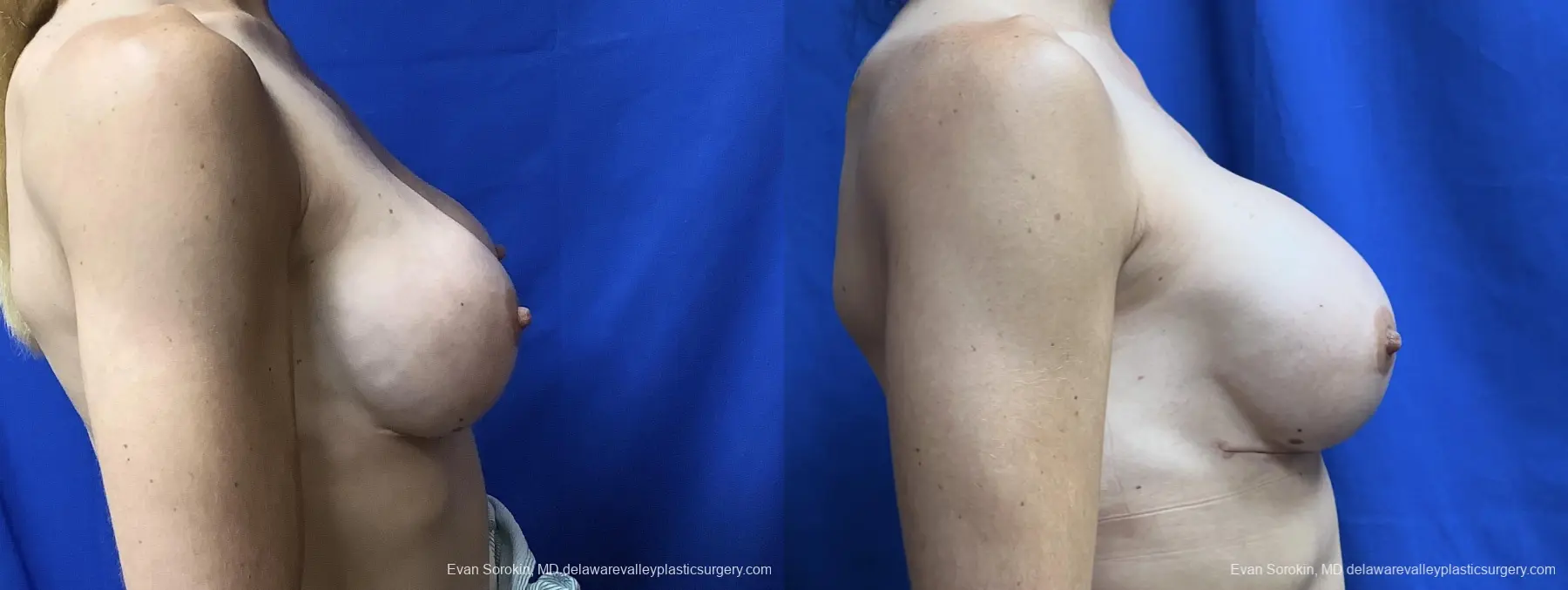 Breast Augmentation Revision: Patient 34 - Before and After 3