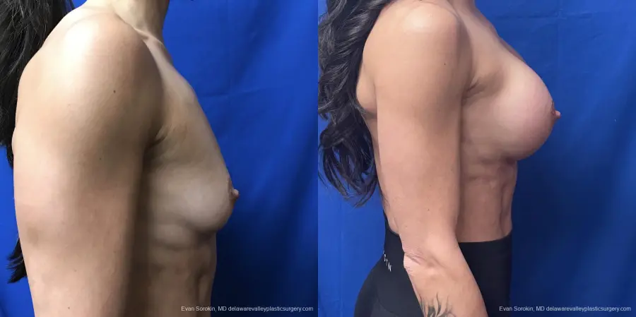 Breast Augmentation: Patient 218 - Before and After 5
