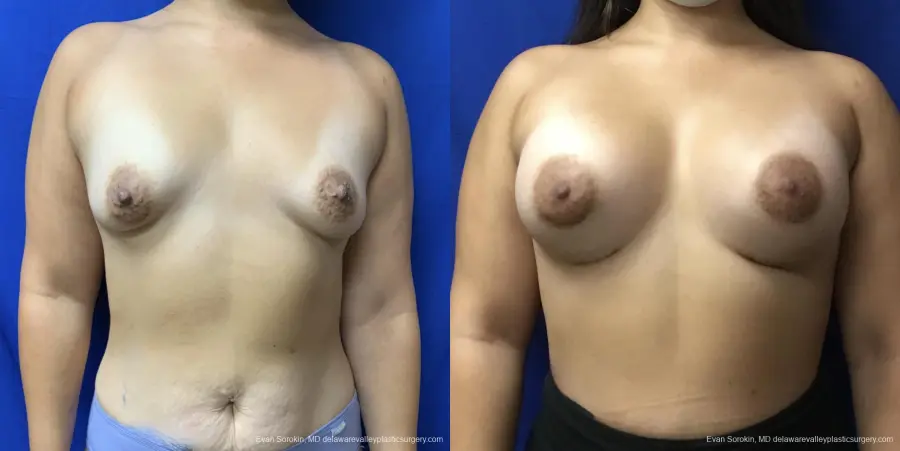Breast Augmentation: Patient 177 - Before and After 1