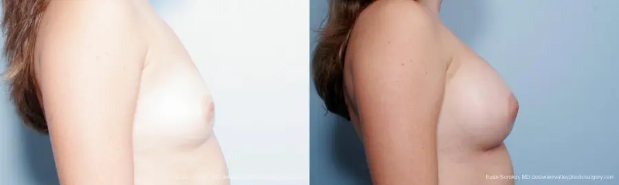 Philadelphia Breast Augmentation 9357 - Before and After 3