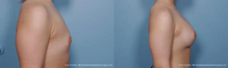 Philadelphia Breast Augmentation 9378 - Before and After 3
