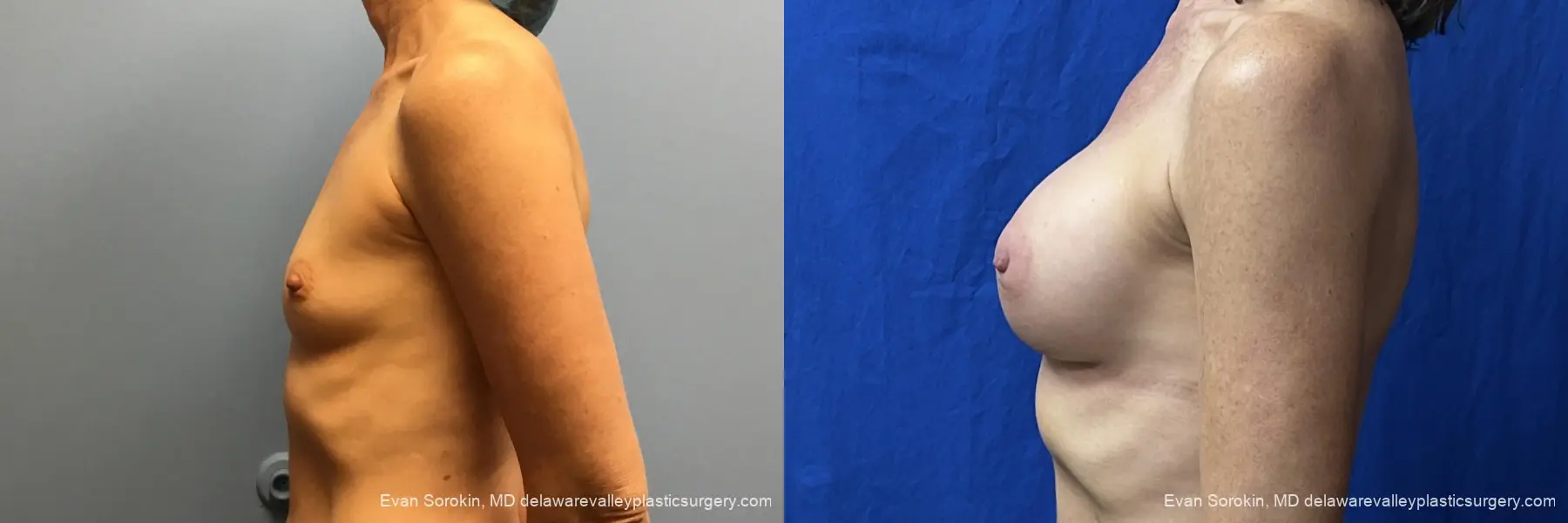 Breast Augmentation: Patient 6 - Before and After 5