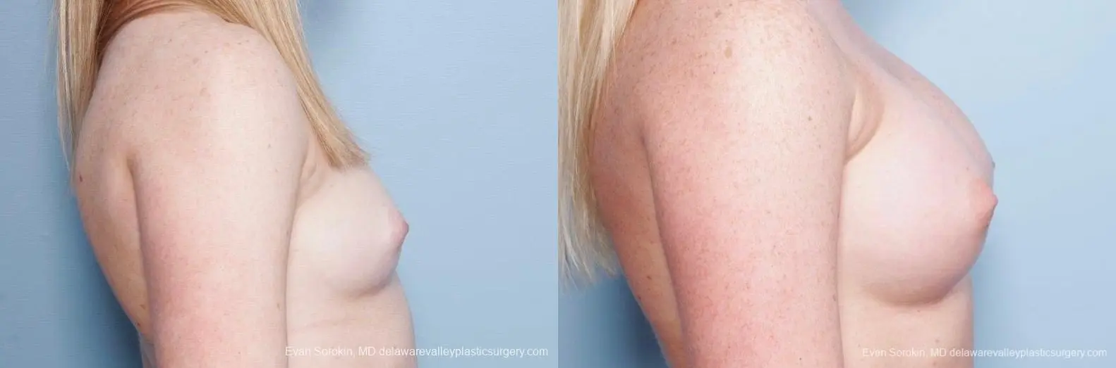 Philadelphia Breast Augmentation 8778 - Before and After 4