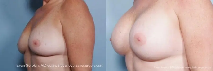 Philadelphia Breast Augmentation 9316 - Before and After 4