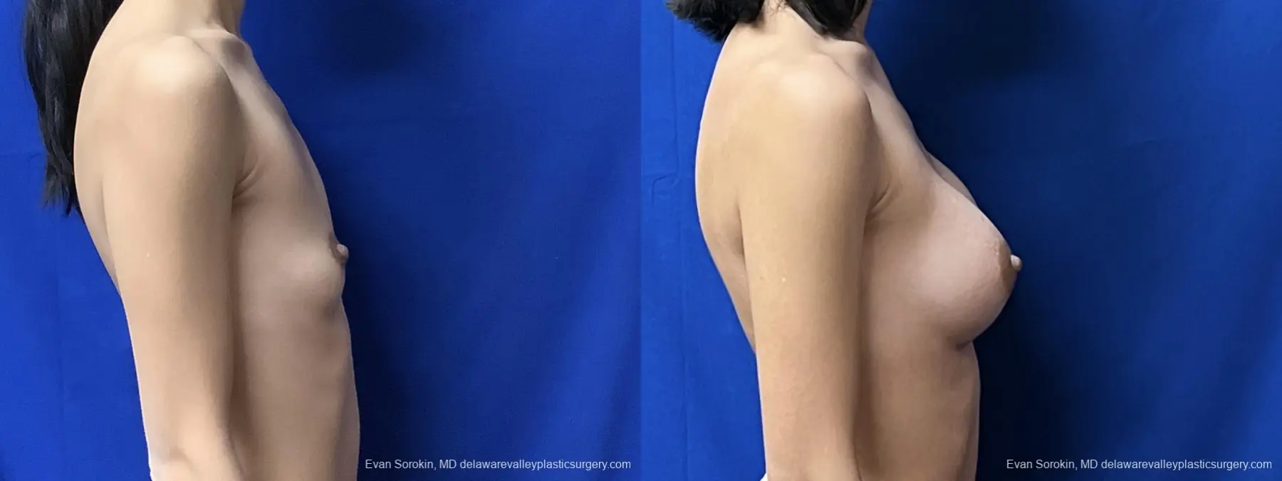 Breast Augmentation: Patient 208 - Before and After 3