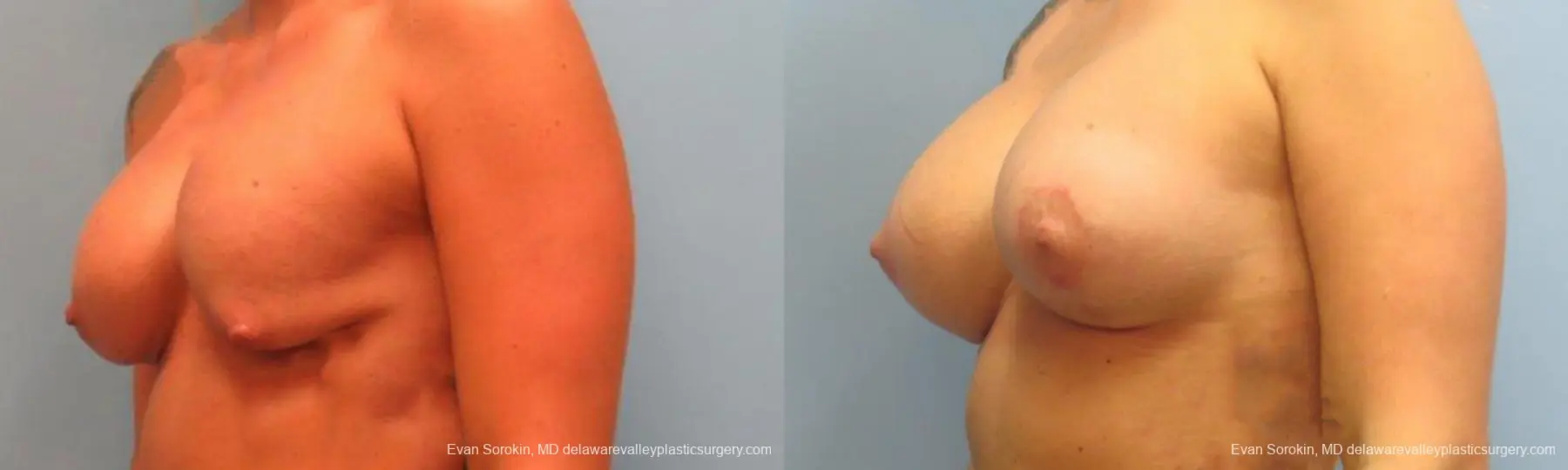 Philadelphia Breast Augmentation 9369 - Before and After 2