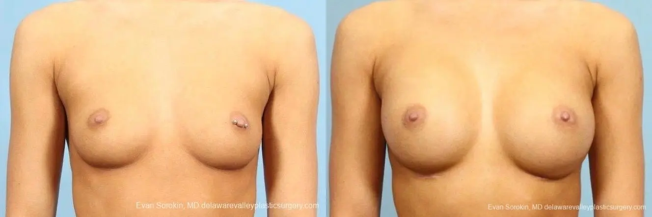 Philadelphia Breast Augmentation 8769 - Before and After 1