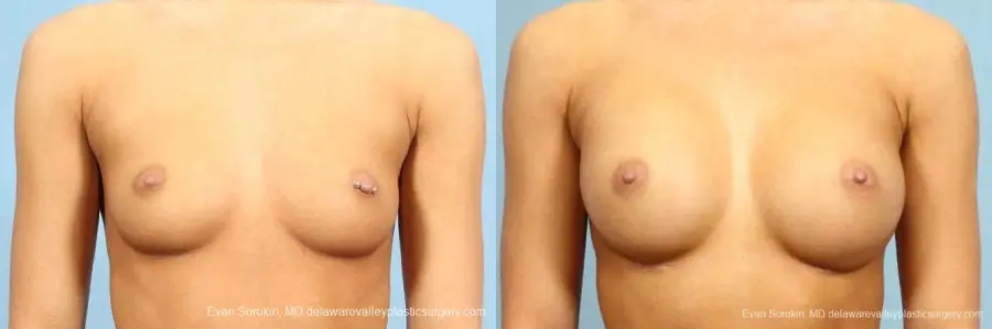 Philadelphia Breast Augmentation 8769 - Before and After 1