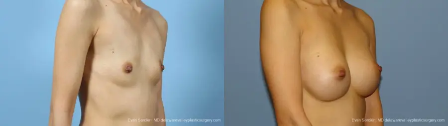 Philadelphia Breast Augmentation 9291 - Before and After 2