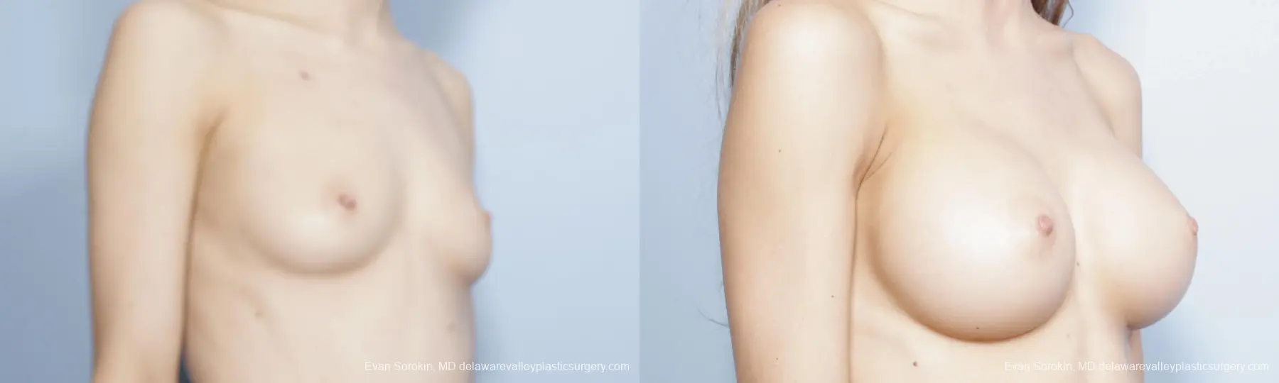 Philadelphia Breast Augmentation 8644 - Before and After 2