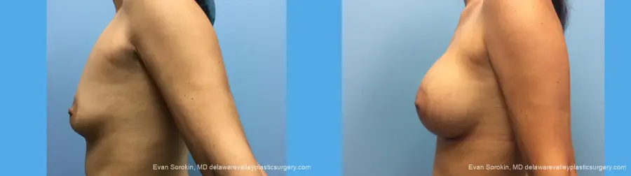 Breast Augmentation: Patient 137 - Before and After 3