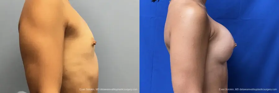 Breast Augmentation: Patient 208 - Before and After 3