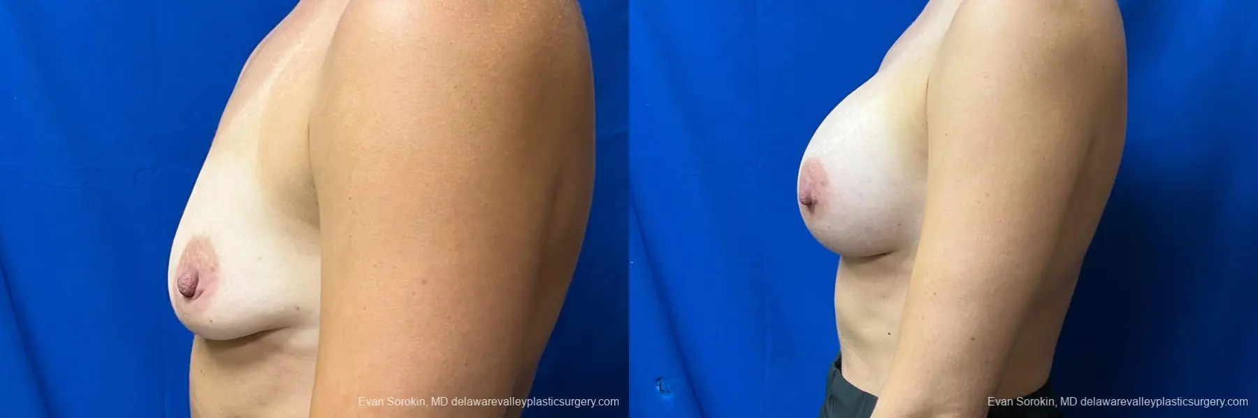 Breast Augmentation: Patient 203 - Before and After 5