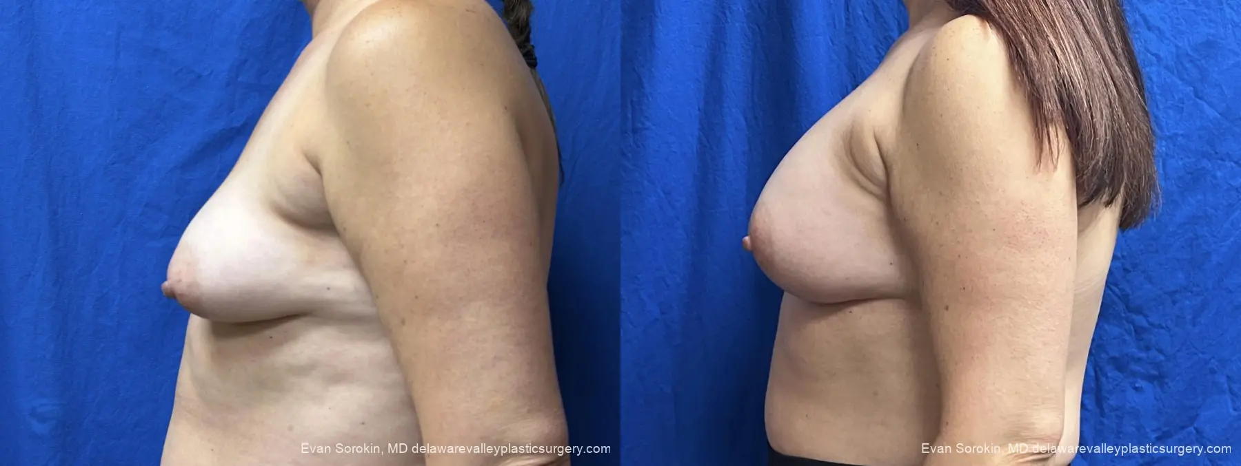 Breast Augmentation: Patient 314 - Before and After 5