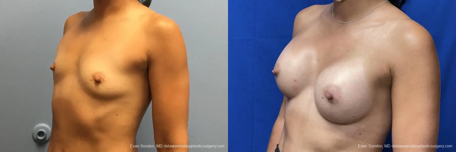 Breast Augmentation: Patient 180 - Before and After 4