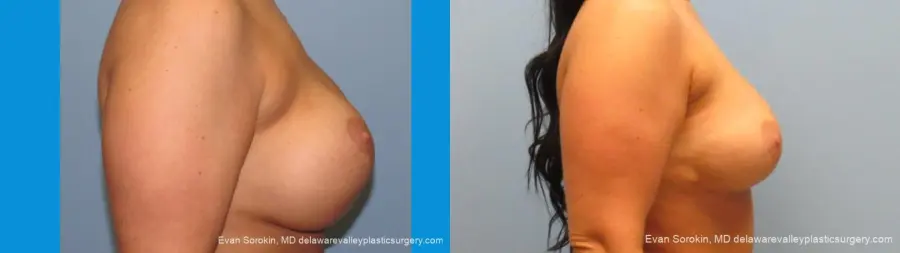 Philadelphia Breast Augmentation 10089 - Before and After 3