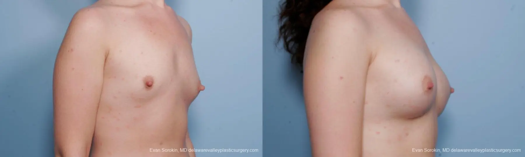 Philadelphia Breast Augmentation 9176 - Before and After 2