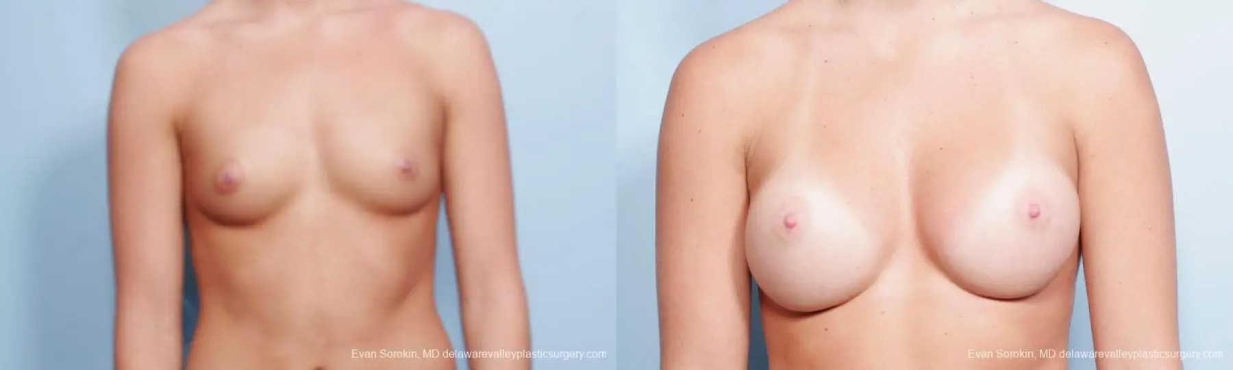 Philadelphia Breast Augmentation 9304 - Before and After 1