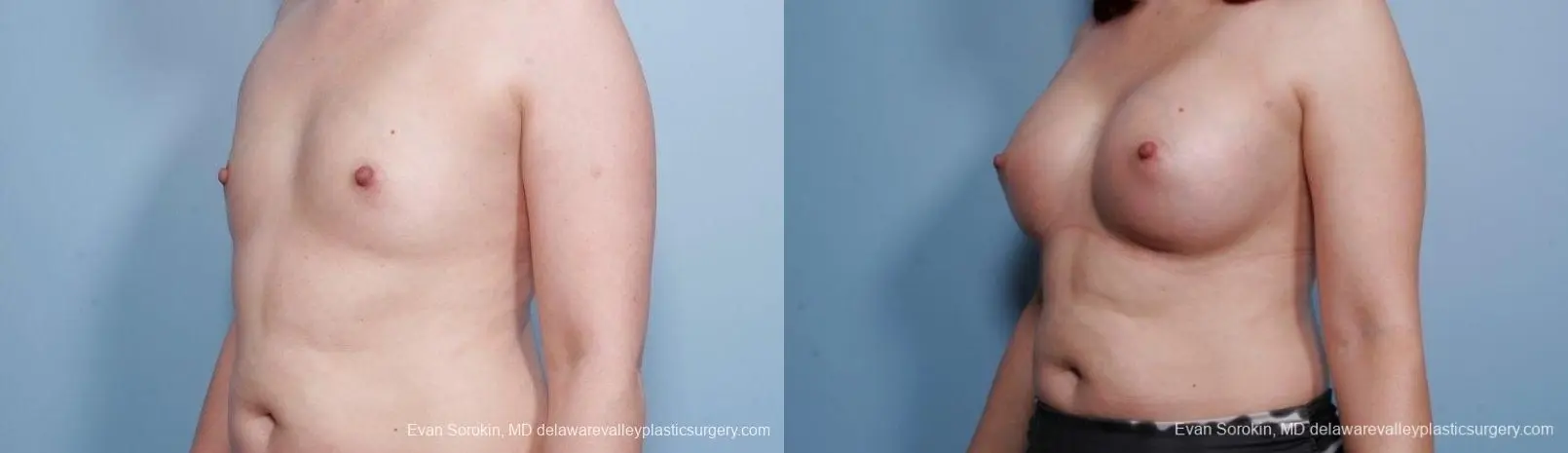 Breast Augmentation: Patient 64 - Before and After 4
