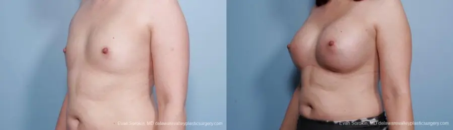 Breast Augmentation: Patient 54 - Before and After 4