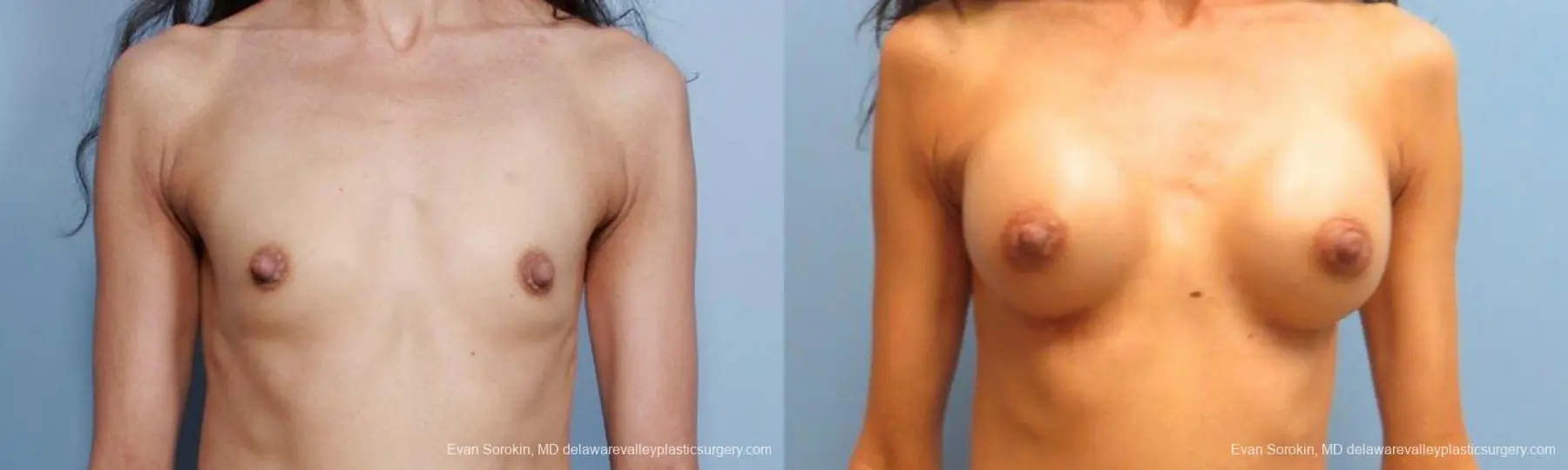 Philadelphia Breast Augmentation 9424 - Before and After 1