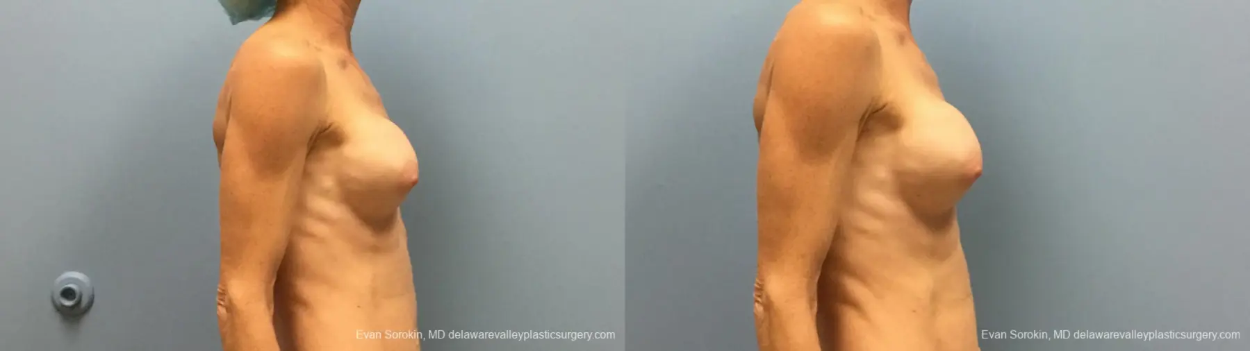 Philadelphia Breast Augmentation 13182 - Before and After 5