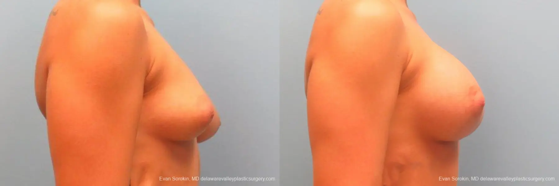 Philadelphia Breast Augmentation 9344 - Before and After 3