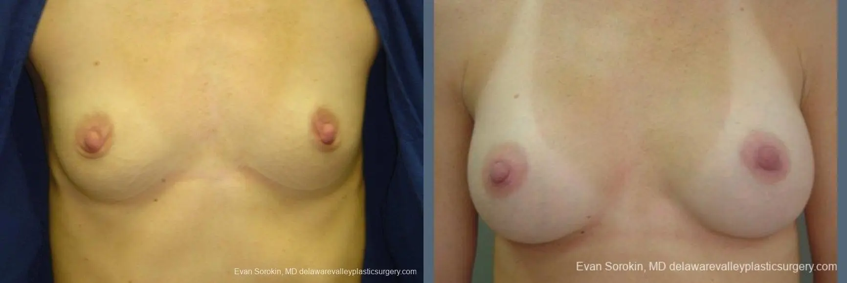 Philadelphia Breast Augmentation 9403 - Before and After 1