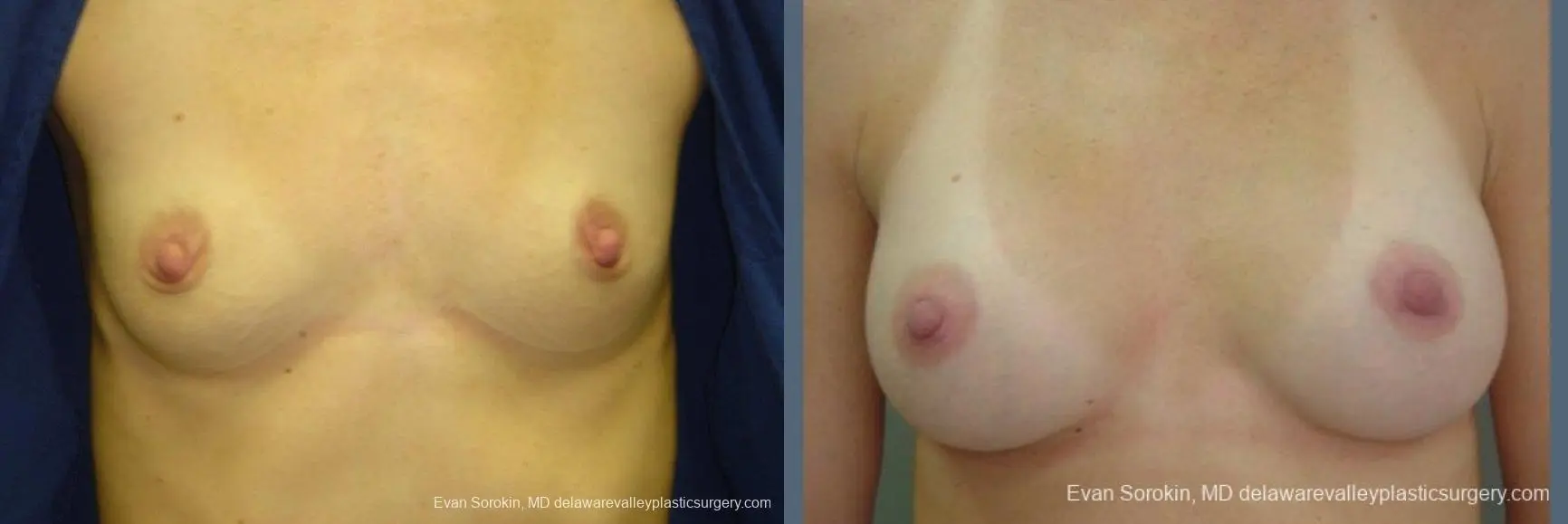 Philadelphia Breast Augmentation 9403 - Before and After