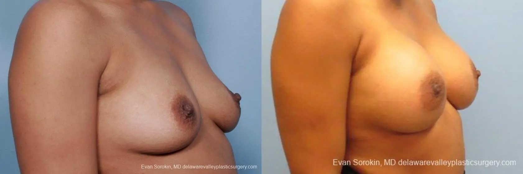 Philadelphia Breast Augmentation 9387 - Before and After 2