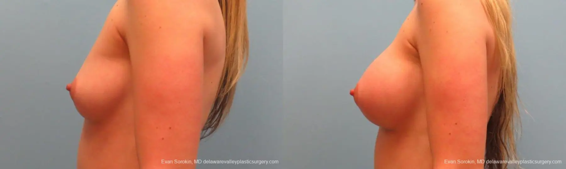 Philadelphia Breast Augmentation 9381 - Before and After 5