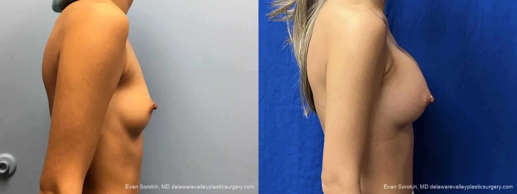 Breast Augmentation: Patient 327 - Before and After 3