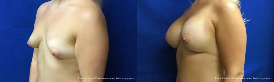 Philadelphia Breast Augmentation 12517 - Before and After 3