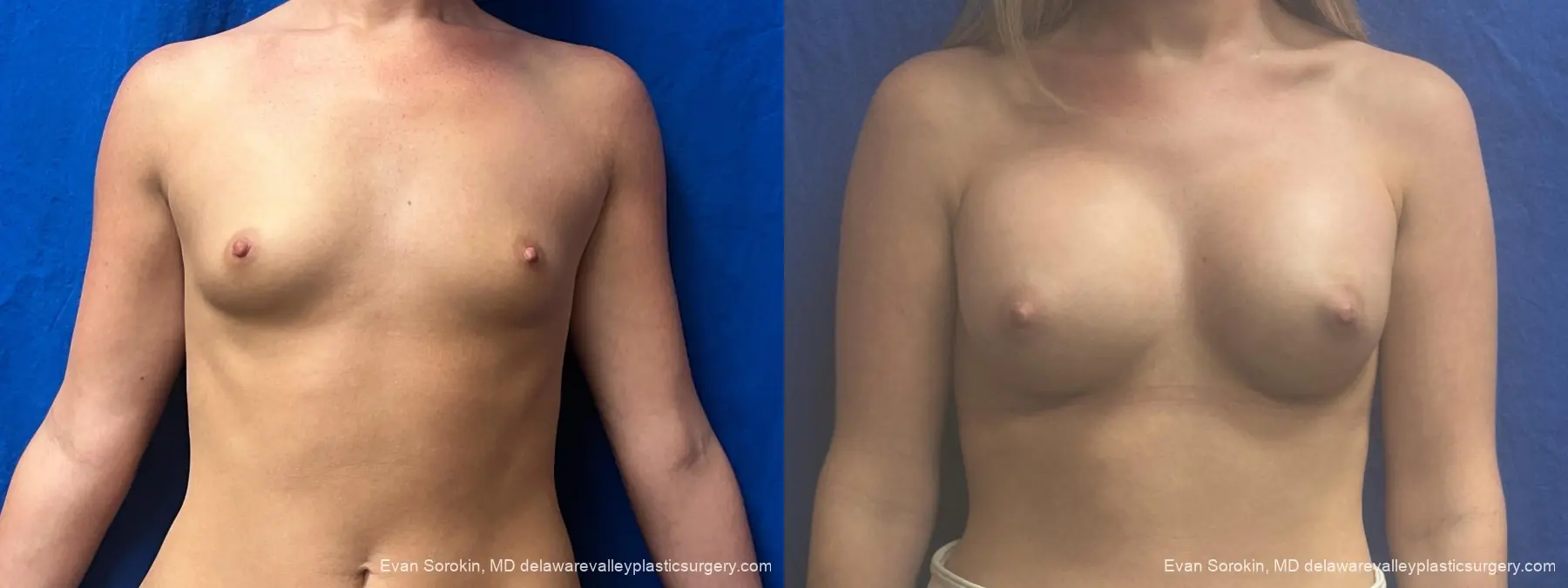 Breast Augmentation: Patient 328 - Before and After 1